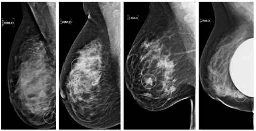 Rango de interpretación del radiólogo en un programa de cribado de 1 millón de mamografías digitales.