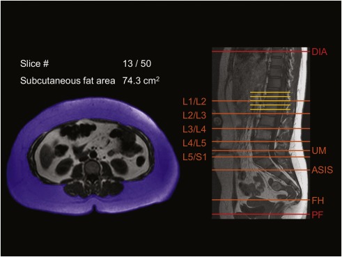 Estimació del volum de greix subcutani abdominal en adults obesos a partir de dades de ressonància magnètica de tall únic: coeficients de regressió i concordança