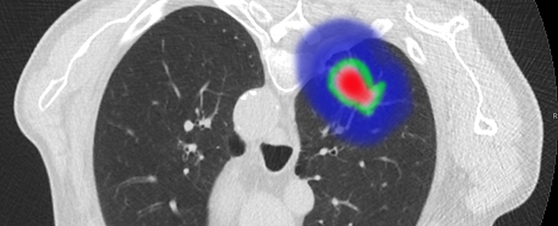 Viabilitat de la radioteràpia hipofraccionada en pacients amb (CPNM) amb ganglis positius inoperables amb factors de pronòstic precari i reserva pulmonar limitada: un estudi observacional prospectiu.