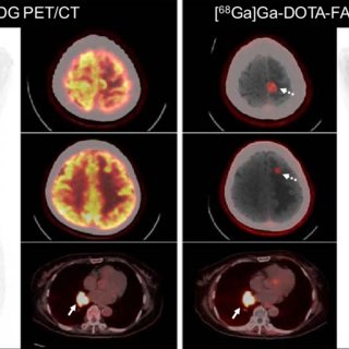 Comparació entre [68Ga] Ga-DOTA-FAPI-04 i [18F] FDG PET/CT per al diagnòstic de lesions primàries i metastàsiques de diferents tipus de càncer.