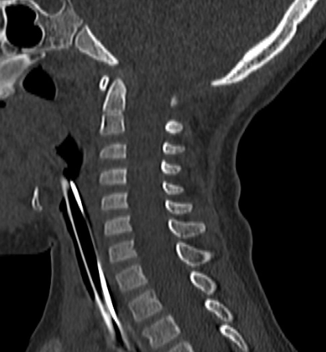 Lesiones de la columna cervical pediátrica en TC: diferencia en la precisión de las interpretaciones por parte de radiólogos pediátricos frente a radiólogos no pediátricos.