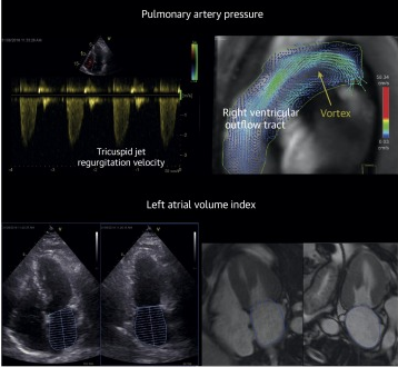 Clasificación de la función diastólica por resonancia magnética con buena concordancia en comparación con ecocardiografía.