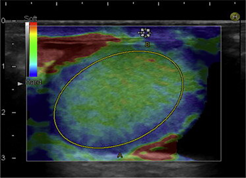 Evidencia radiológica de daño testicular en casos de Coronavirus del Síndrome Respiratorio Agudo Grave 2. Un potencial rol de la sonoelastografía.