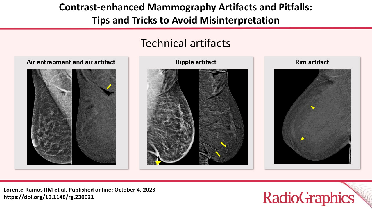 Artefactes i Pitfalls de la mamografia amb contrast: Consells i trucs per evitar interpretacions errònies.