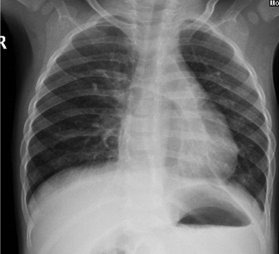 Estudio para la modificación de los parámetros en la radiografía de tórax mediante un fantoma torácico neonatal.